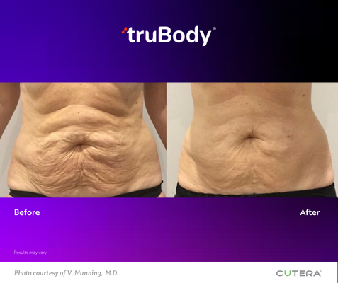 A before and after picture of a woman 's stomach.