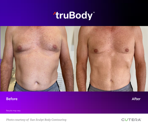 A before and after photo of a man 's chest and abdomen