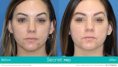 A before and after photo of a woman 's face.
