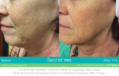 A before and after photo of a woman 's face.