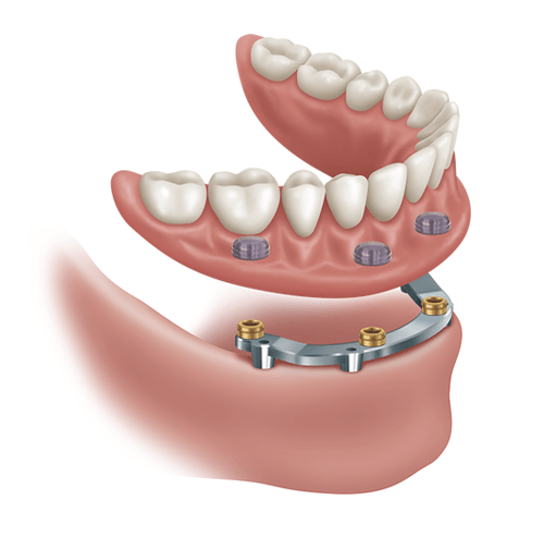 Robbinsville Snap On Dentures Dentist