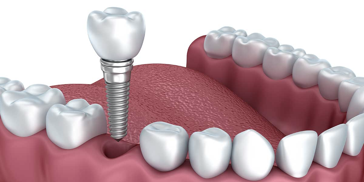 Single-Implant-Dentist-Princeton-NJ