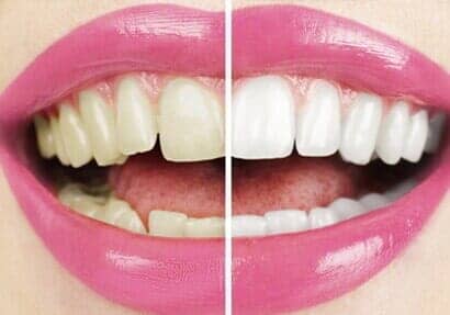 Before and after dental operation - Dental Clinics in Newport News, VA