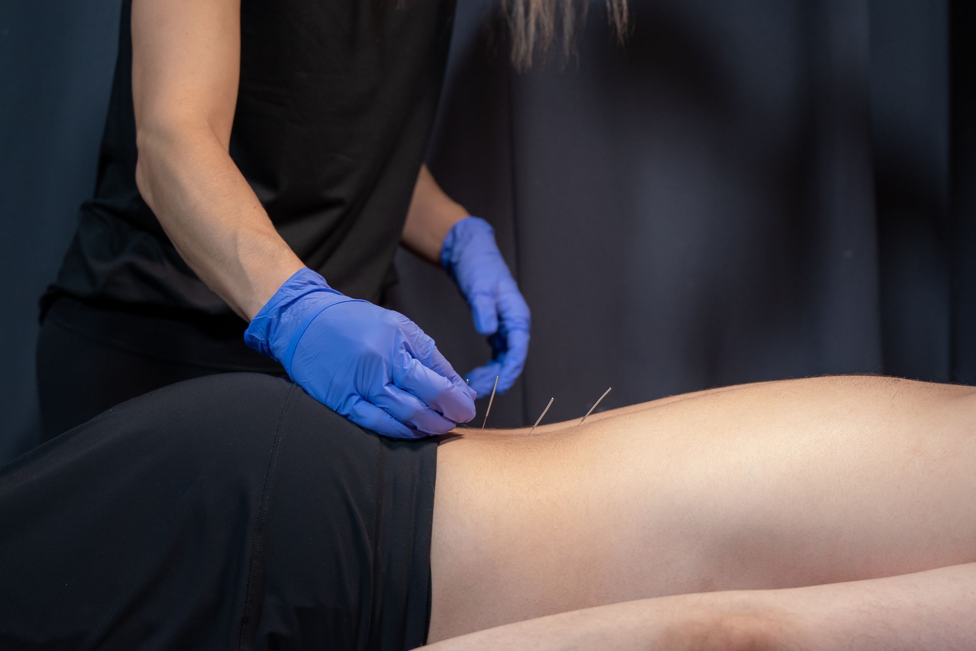 dry needling