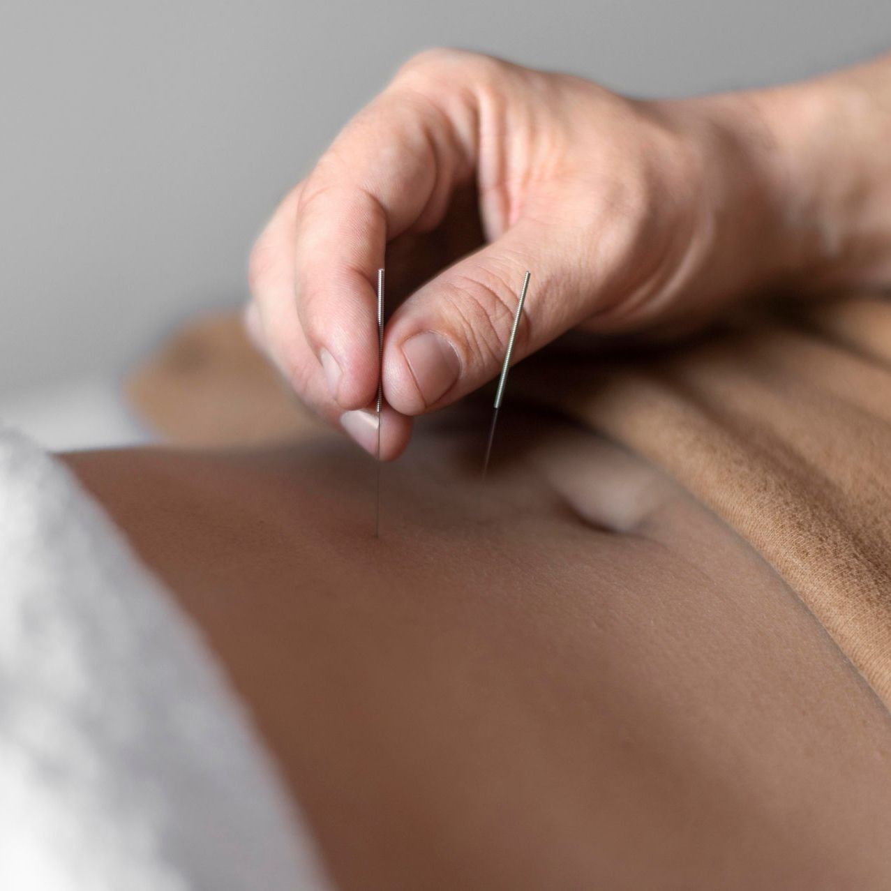 medical acupuncture on stomach