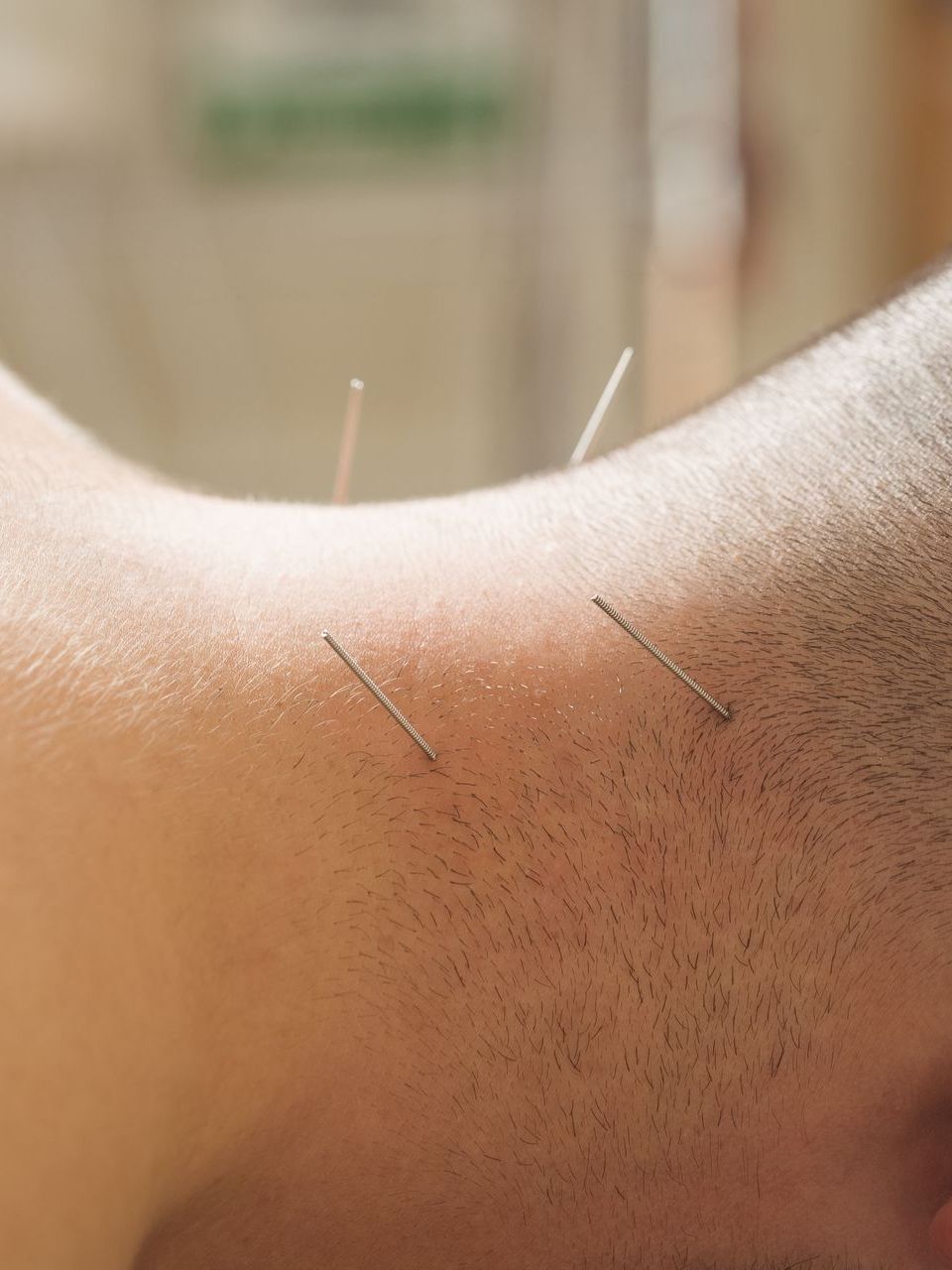 medical acupuncture session