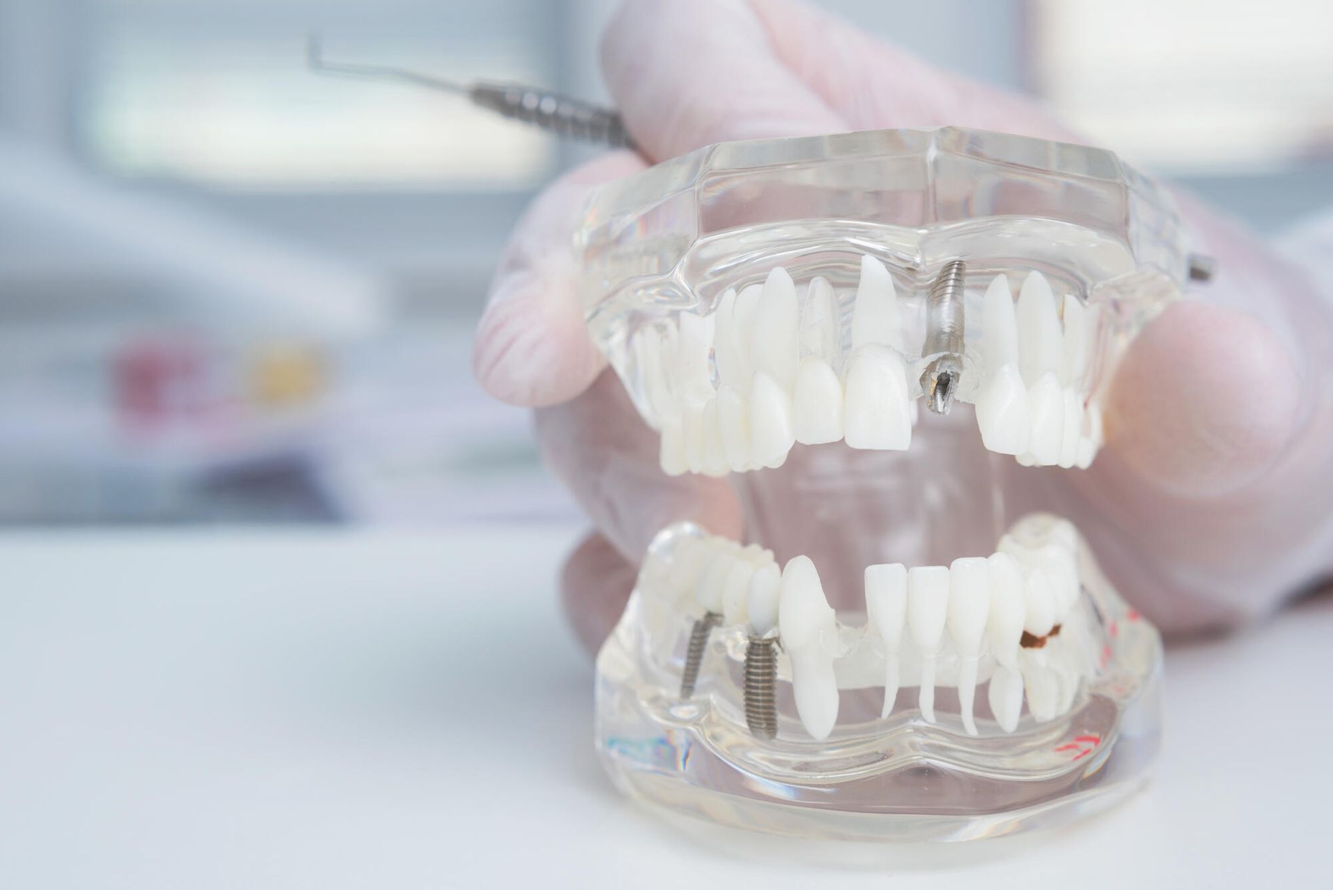 A dentist is holding a model of teeth with dental implants.