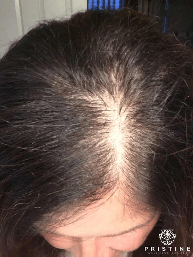 PRP Hair Loss Treatment & Restoration Los Alto, San Ramon