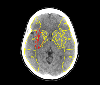 Axial CT scan of a brain, yellow and red highlights, labeled sections, depicting brain structures.