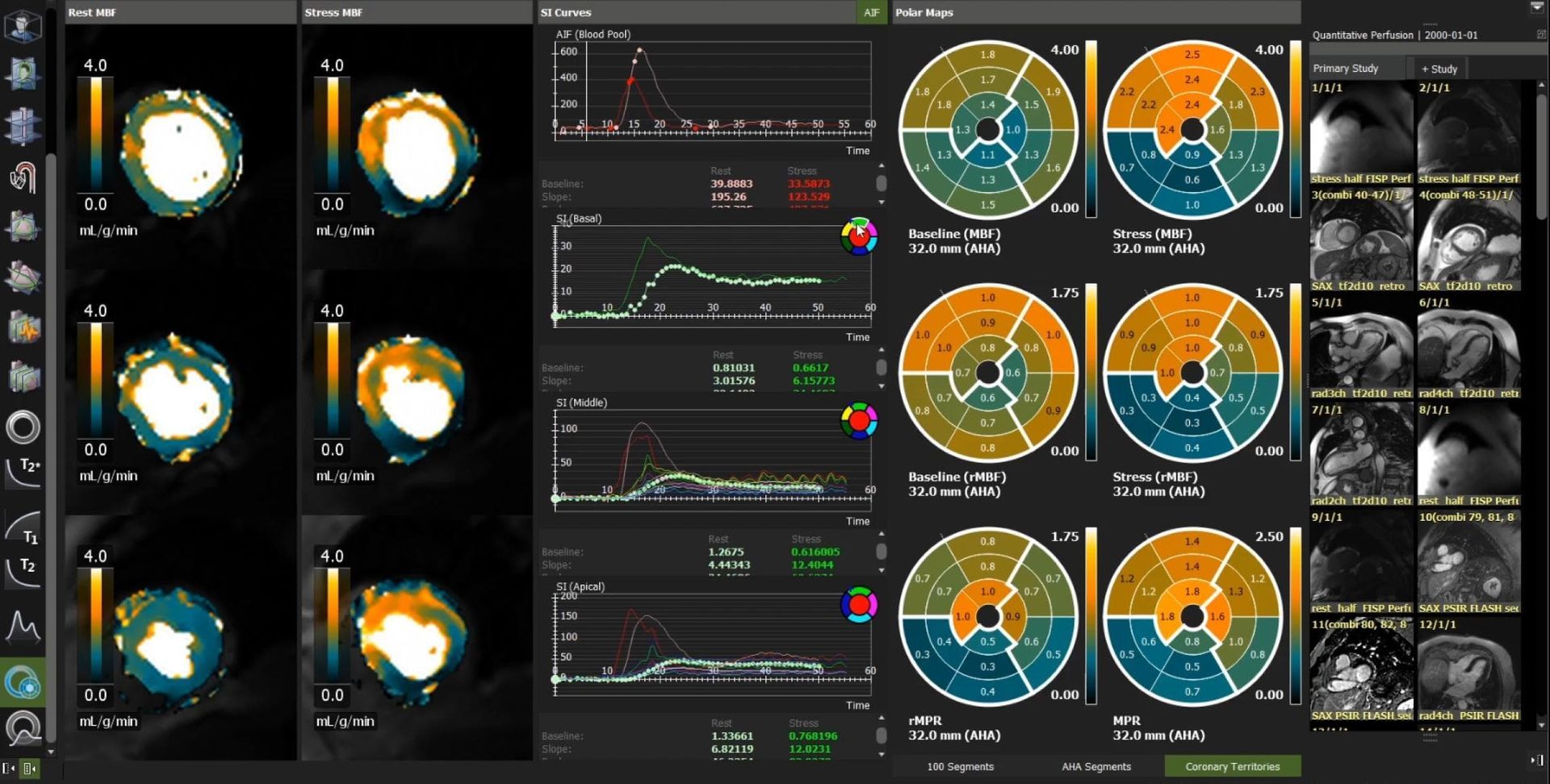 Medical imaging interface with circular and graph data visualizations, displaying heart scans.