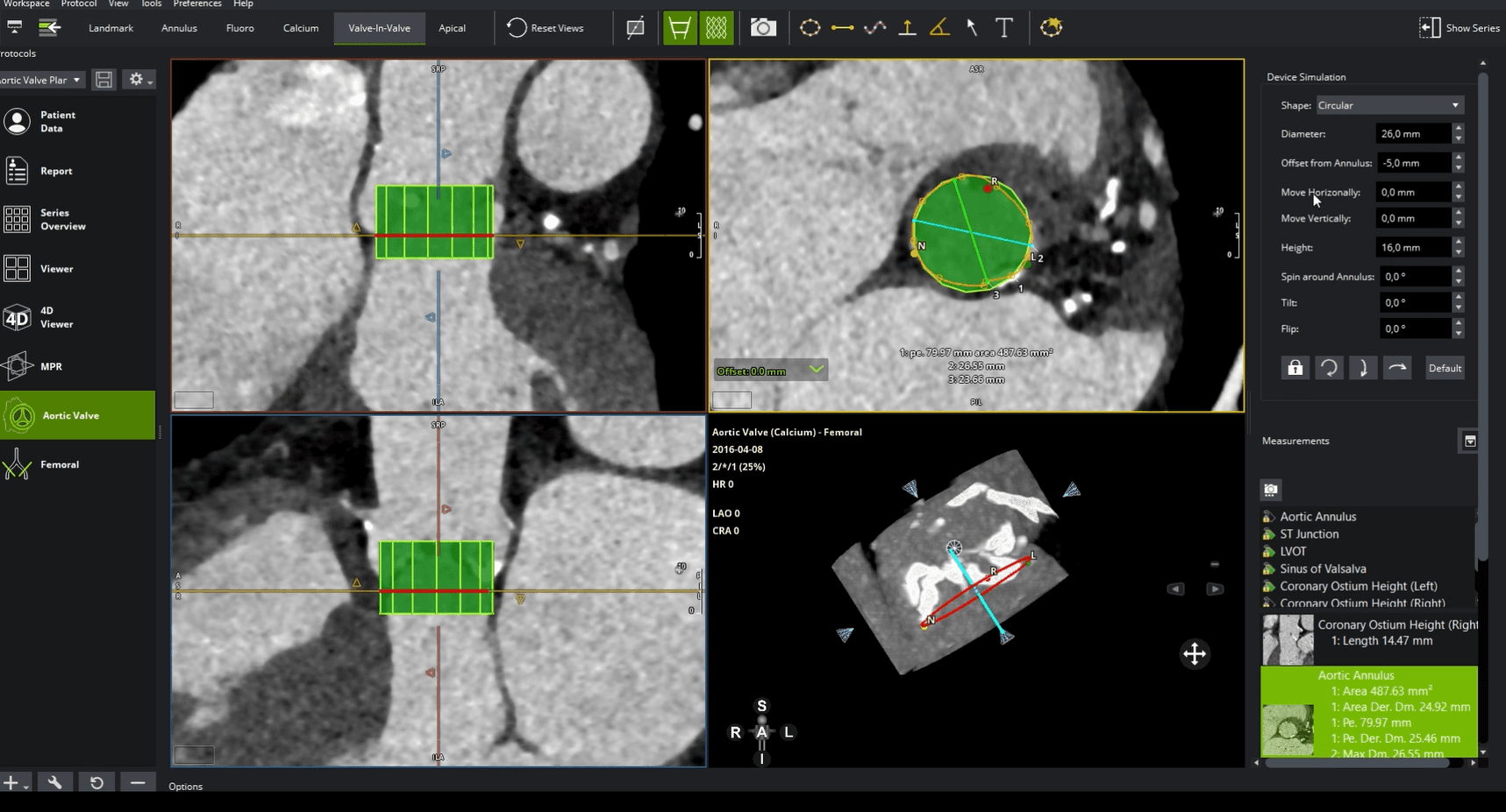 CT scan software interface displaying cross-sectional images of a patient's abdomen and a 3D reconstruction. Green highlights and measurements are present.