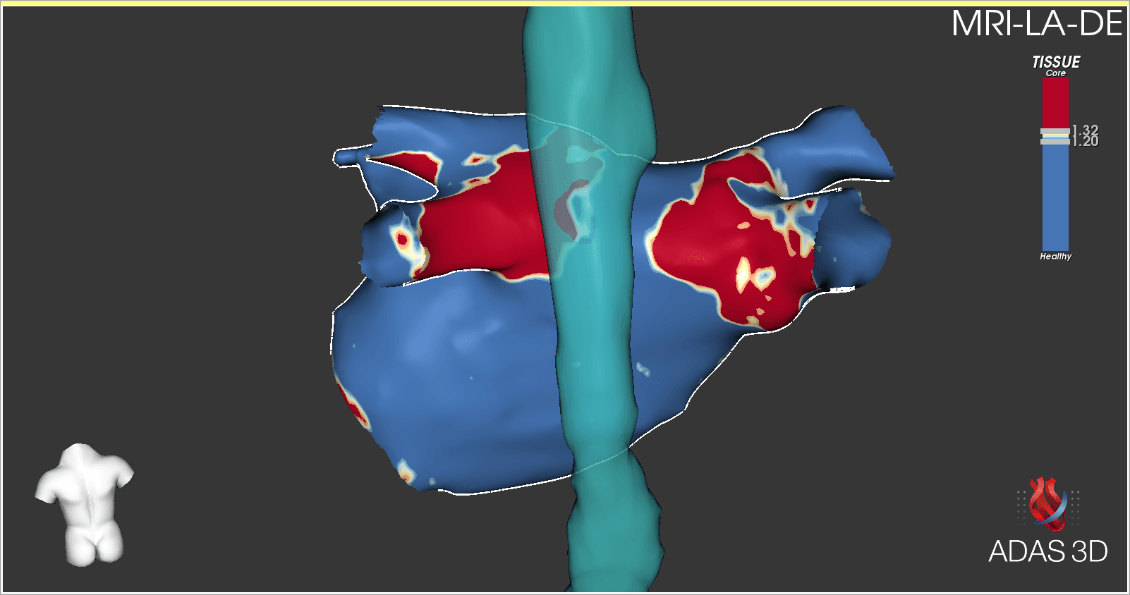 3D MRI scan of a heart, blue and red areas indicating myocardial infarction. A teal, cylindrical structure runs through.