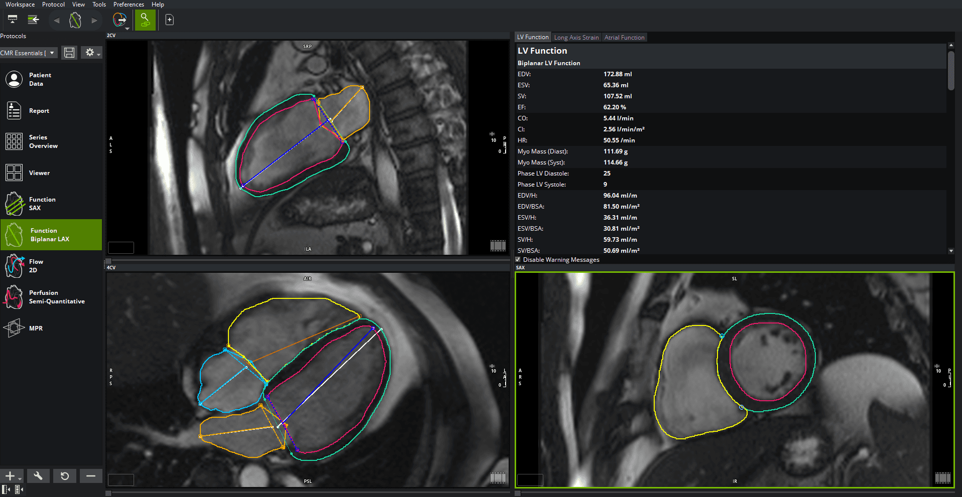 MRI scans of a heart, showing segmented chambers outlined in various colors, alongside analysis data.