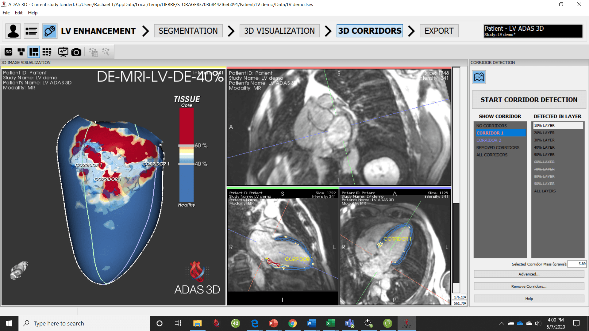 Medical software interface displaying cardiac MRI data. 3D heart model with red/blue areas, MRI slices, and selectable options.