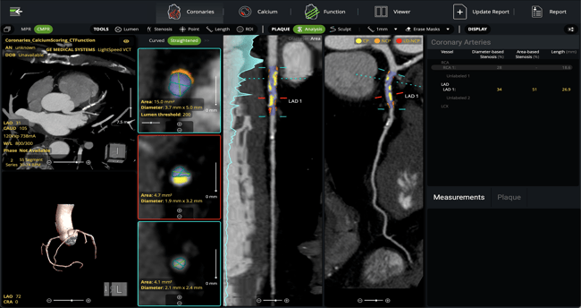 Medical imaging software interface displaying cross-sections, 3D renderings, and measurements of coronary arteries.
