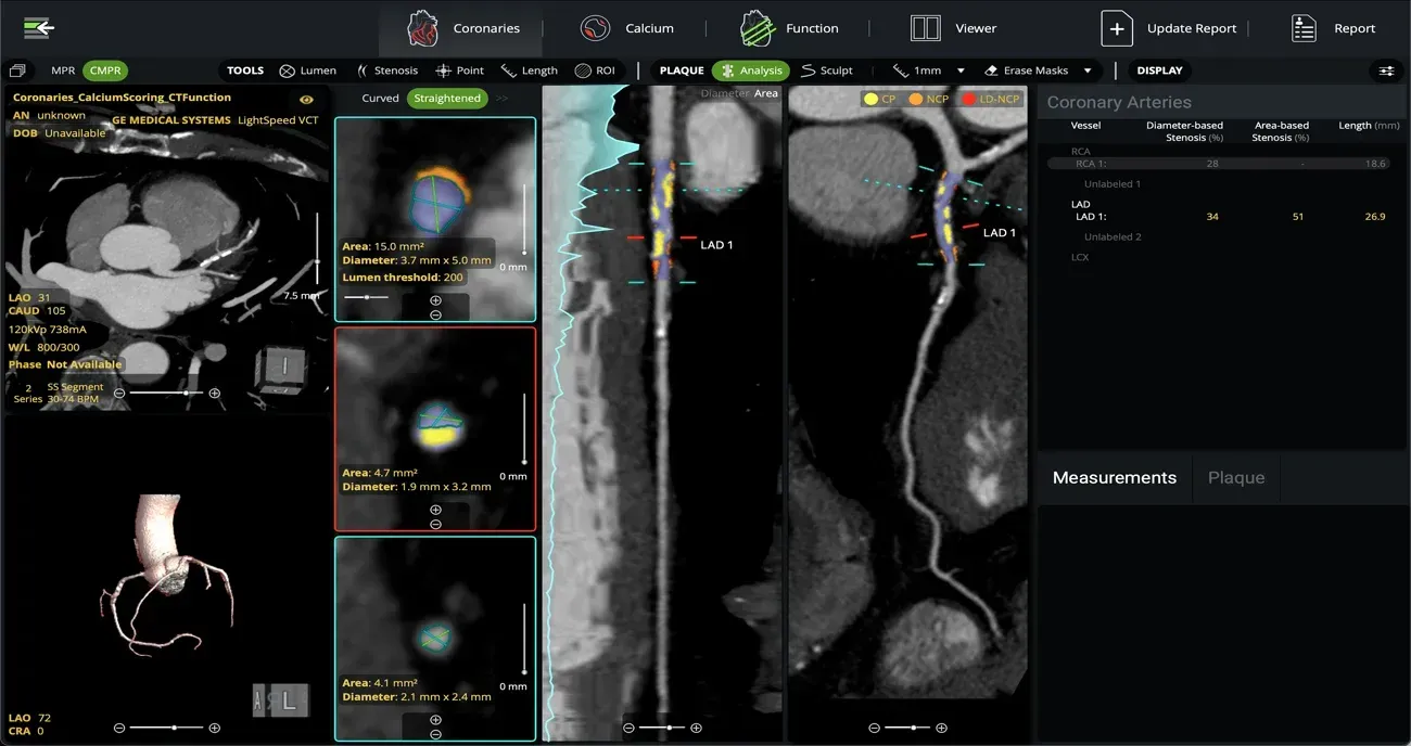 CT scan analysis interface showing heart and vascular structures with color-coded highlights.