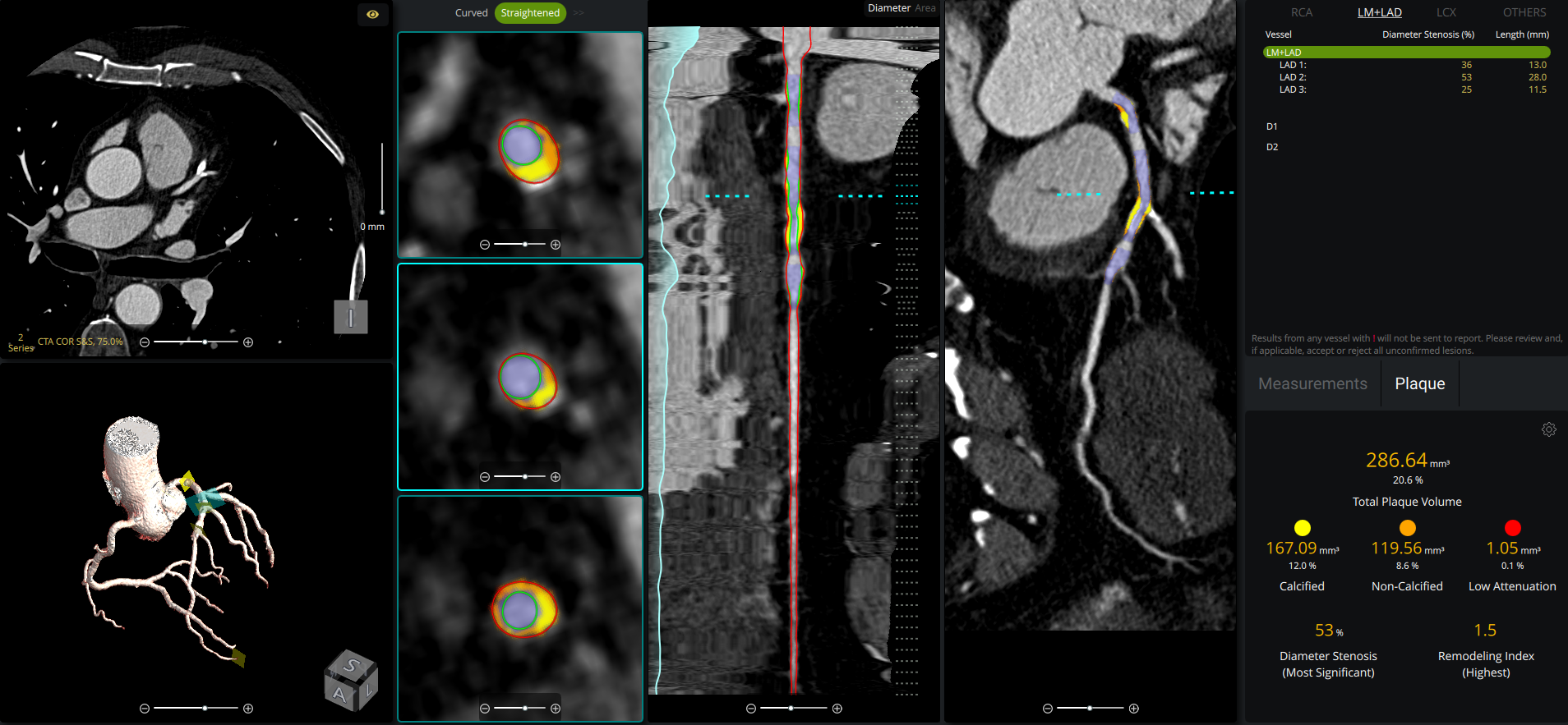 Medical imaging display with multiple views of a patient's anatomy, including a heart and blood vessels.