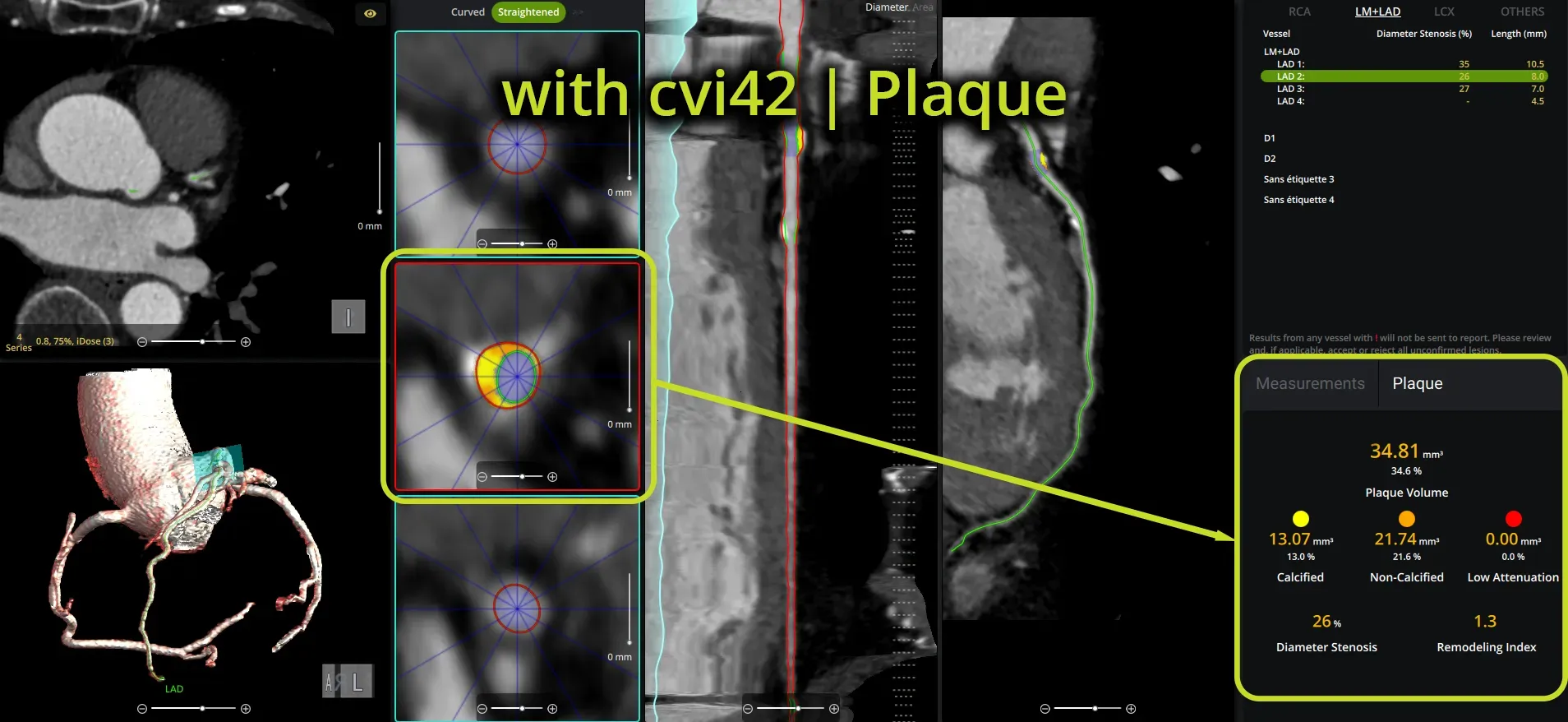 Medical imaging of a heart, showing plaque detection with cvi42 software, highlighting areas of interest in yellow and providing data analysis.