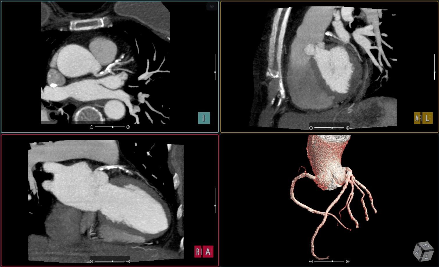 Four-panel cardiac CT scan showing heart anatomy, coronary arteries, and a 3D reconstructed view of the aorta and vessels.