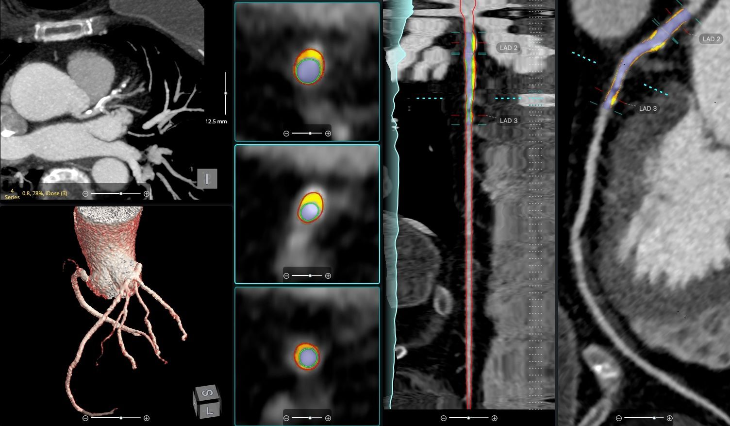 Medical imaging showing cardiac CT scans with colored overlays indicating coronary artery plaque and vessel analysis.