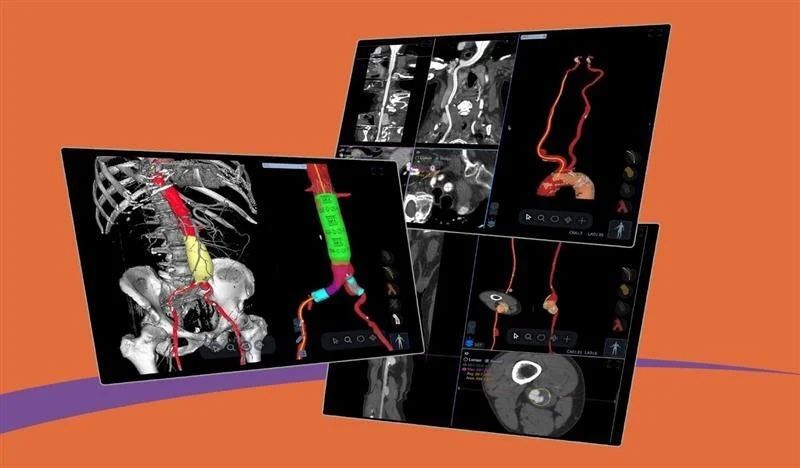 Medical software displays 3D reconstructions and cross-sectional scans of human vascular anatomy against an orange background.