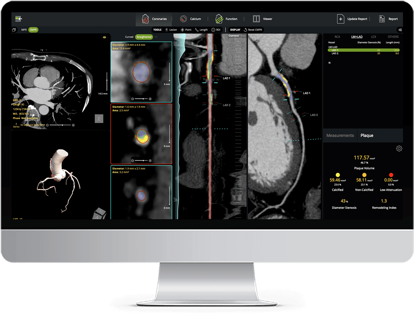 Computer screen displaying medical imaging, showing heart and blood vessels in various formats.