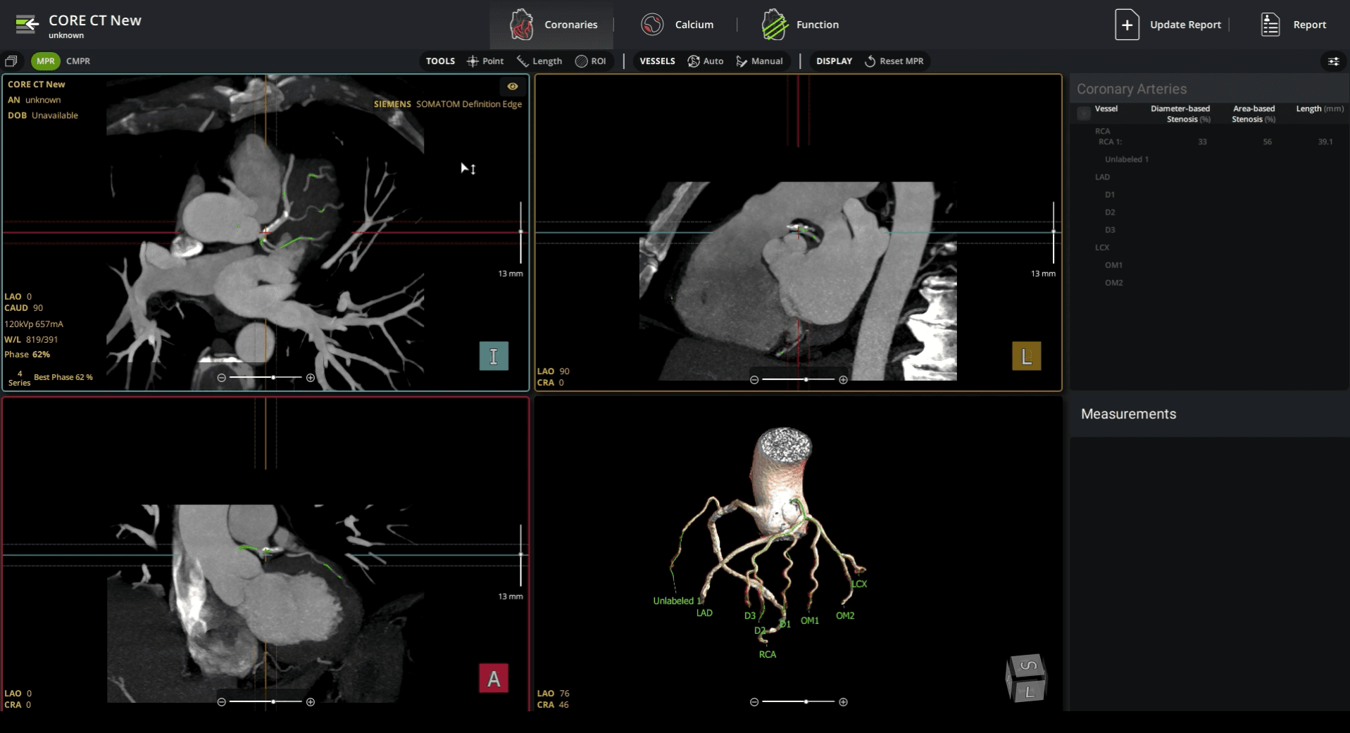 CT scan of a heart. Four views of the heart and coronary arteries displayed on a dark interface.