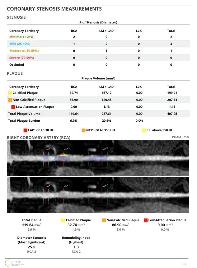 Medical report: Coronary stenosis measurements. Table of stenosis percentages & plaque volumes. Right coronary artery images.