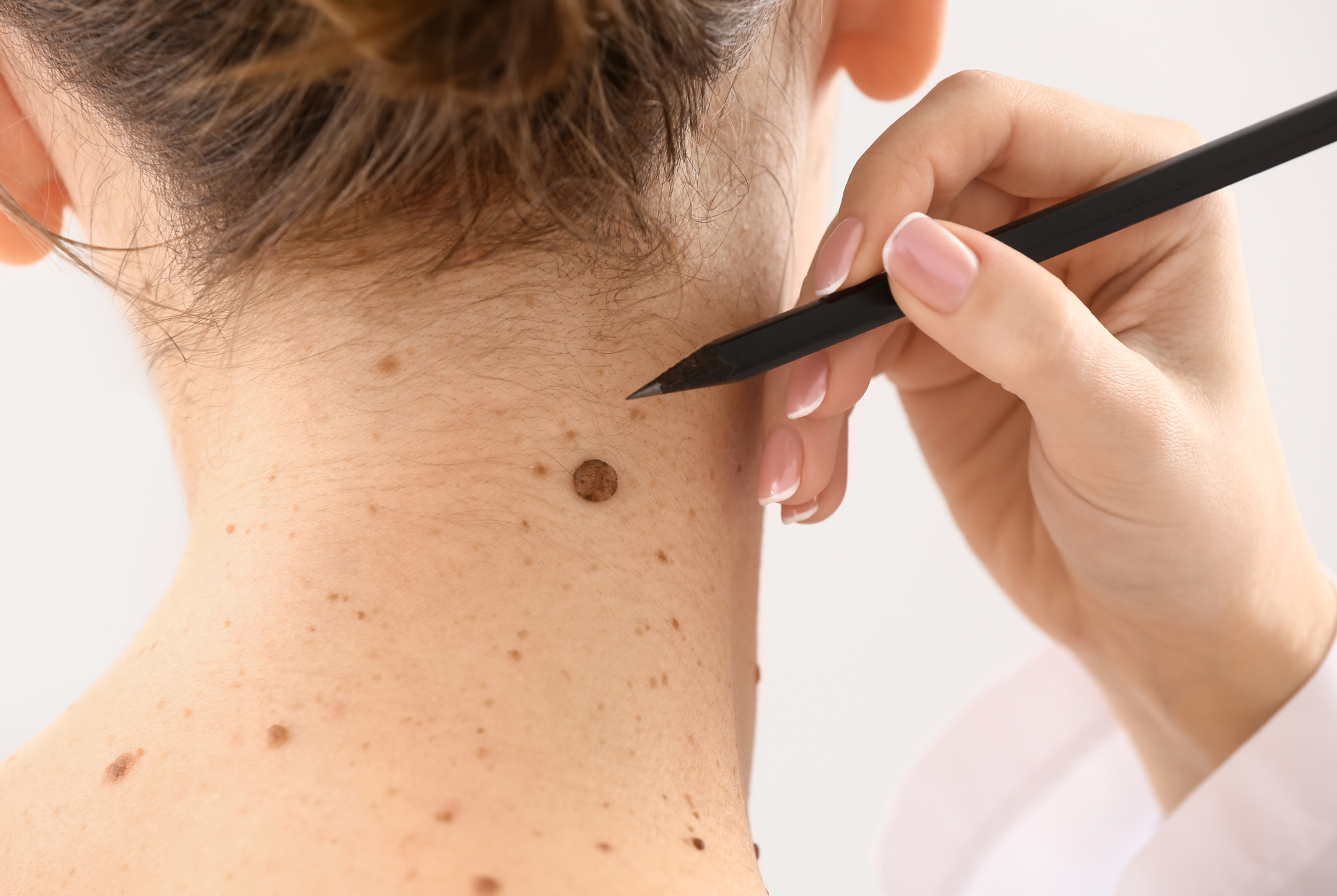 A woman is getting a mole removed from her neck with a pencil.