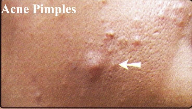 A close up of acne pimples on a person 's face