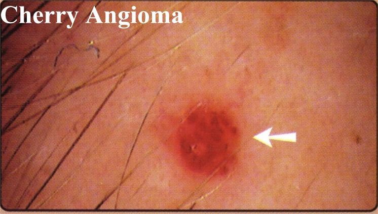 CherryAngioma.jpg