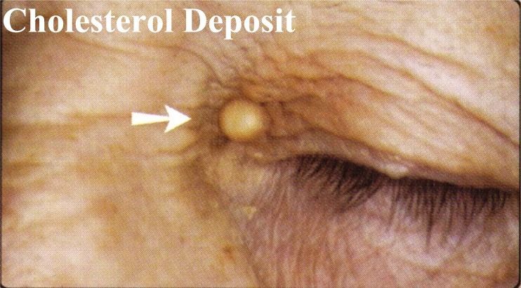 A close up of a person 's eye with an arrow pointing to a cholesterol deposit