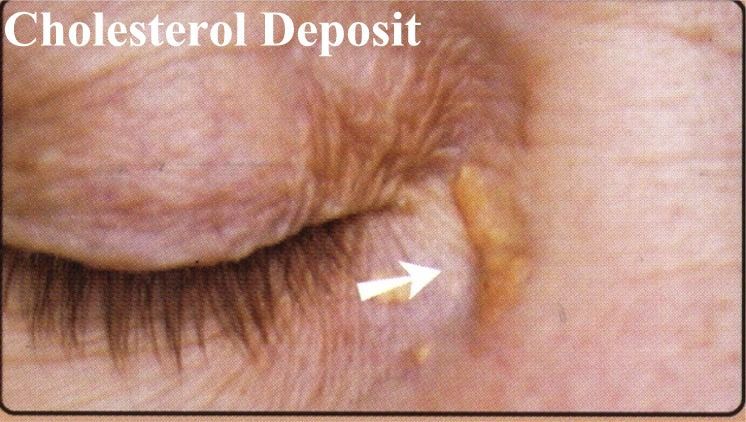 A close up of a person 's eye with an arrow pointing to a cholesterol deposit