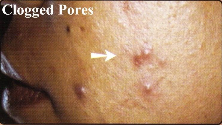 A close up of a person 's face with clogged pores and an arrow pointing to them