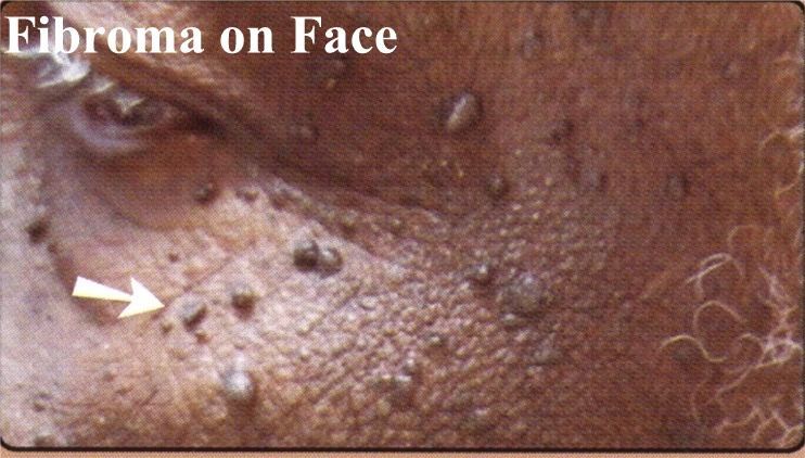 A close up of a person 's face with fibroma on it