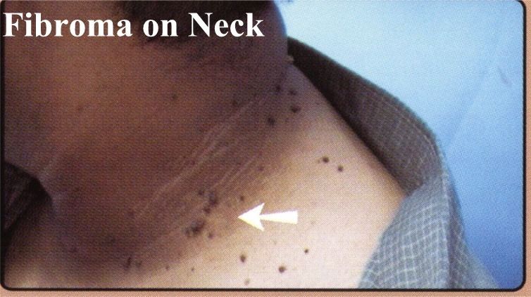 A close up of a person 's neck with fibroma on it