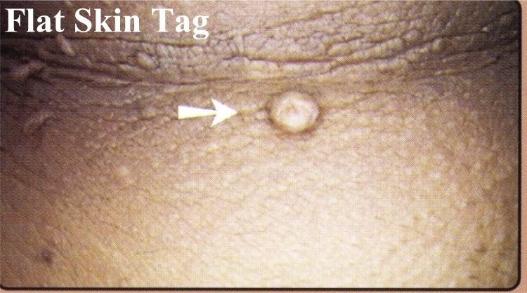 A close up of a flat skin tag on a person 's neck