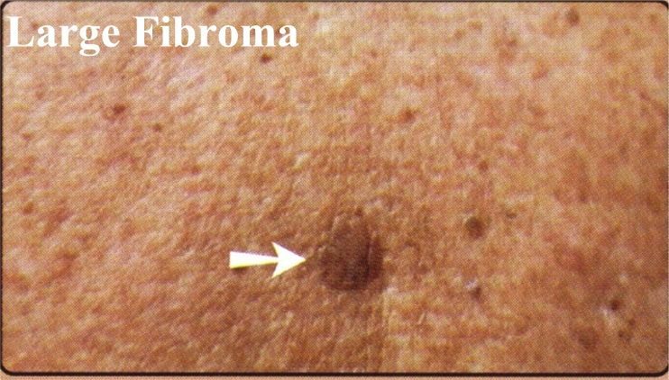 A large fibroma is shown with an arrow pointing to it