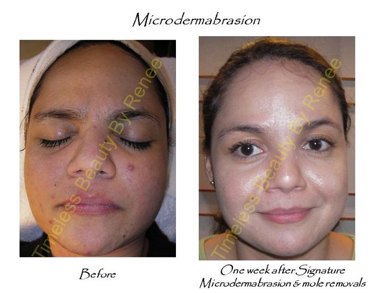 A woman 's face before and after microdermabrasion