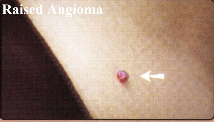 RaisedAngioma.jpg