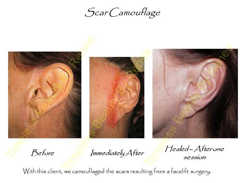 A before and after picture of a woman 's ear with scar camouflage.