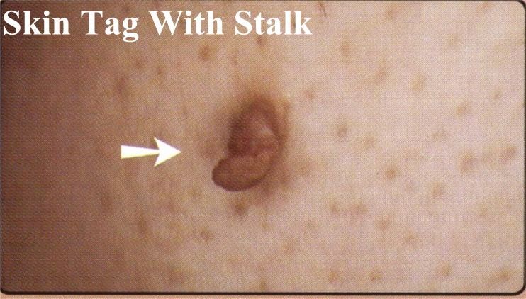 A close up of a skin tag with an arrow pointing to it