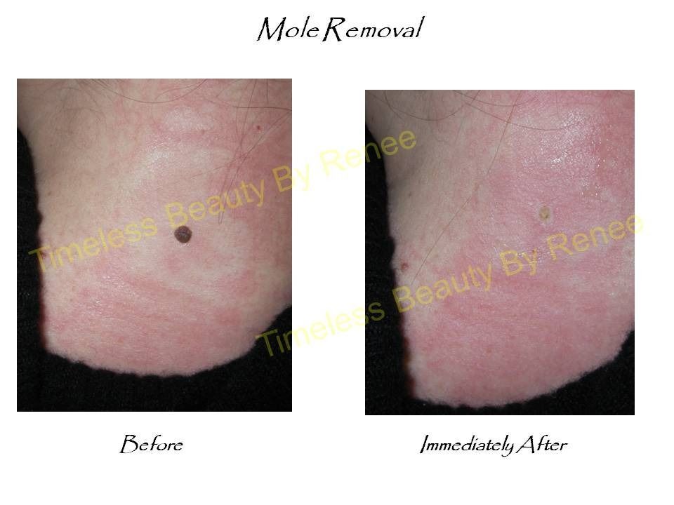 A before and after picture of a mole removal procedure