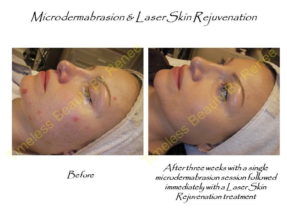 A before and after photo of a woman 's face