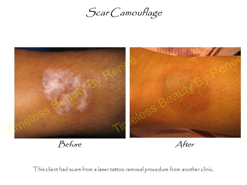 A before and after picture of scar camouflage on a person 's arm