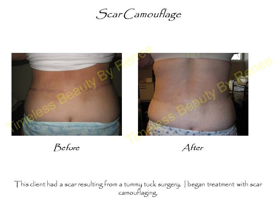 A picture of a woman 's back before and after scar camouflage