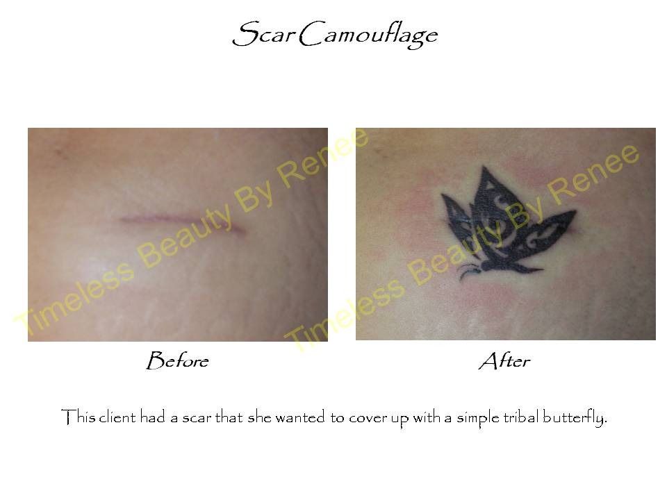 A before and after photo of a scar camouflage tattoo