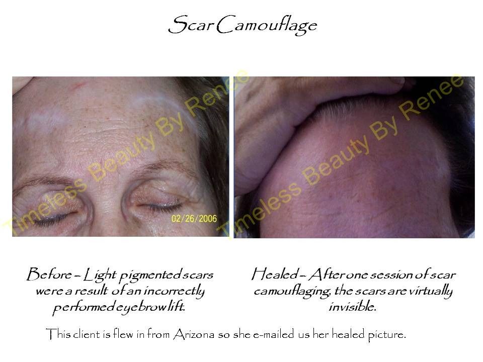 A picture of a woman 's face before and after scar camouflage