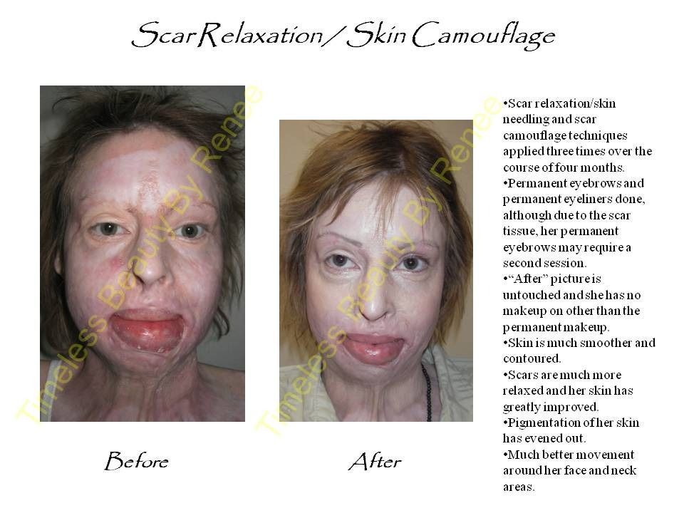 A before and after picture of a woman with scars on her face