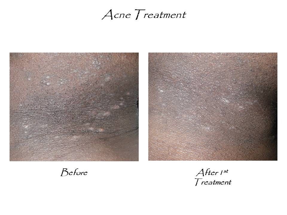A before and after picture of an acne treatment